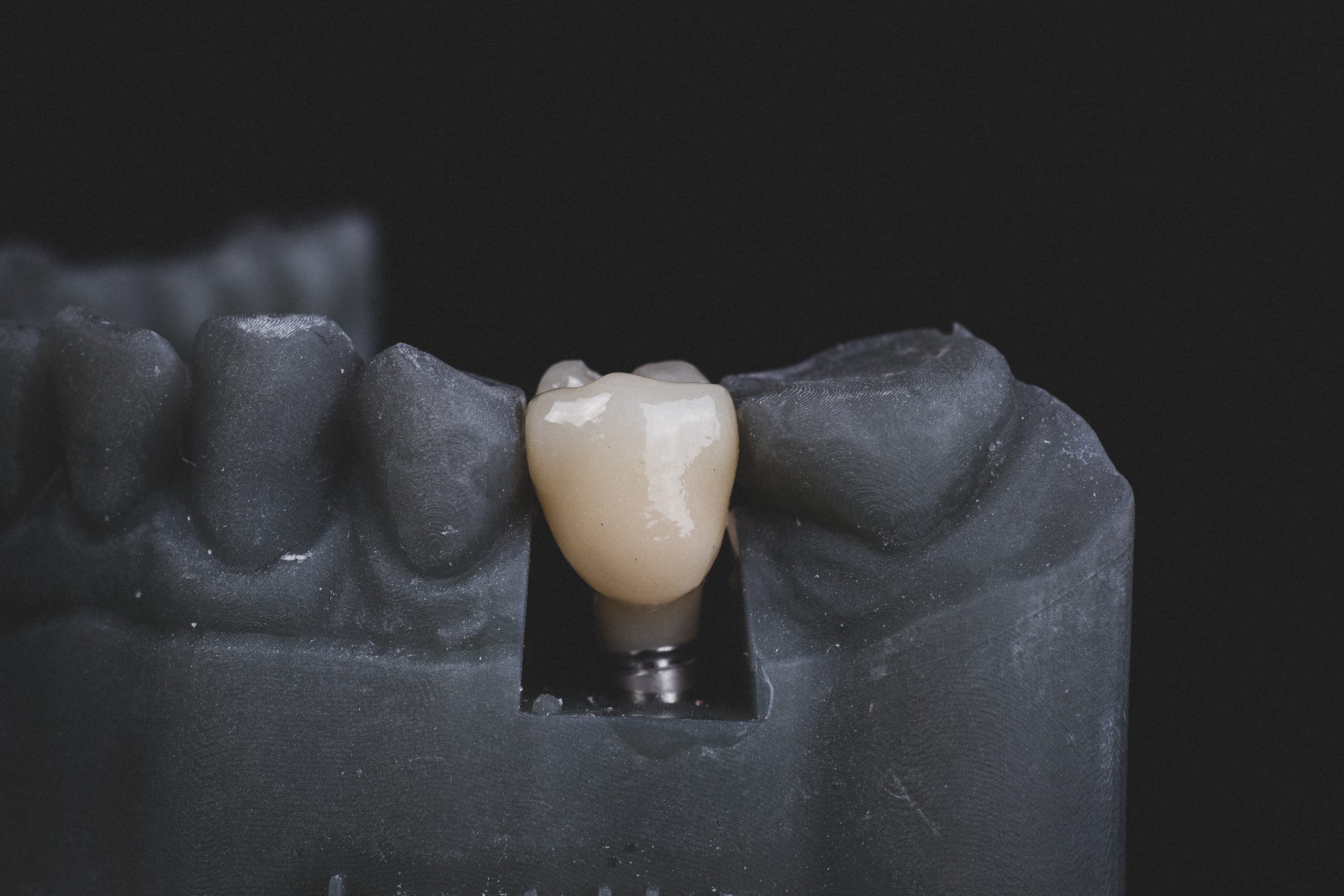 The Ultimate Guide to Dental Implants: Why They’re the Gold Standard for Tooth Replacement