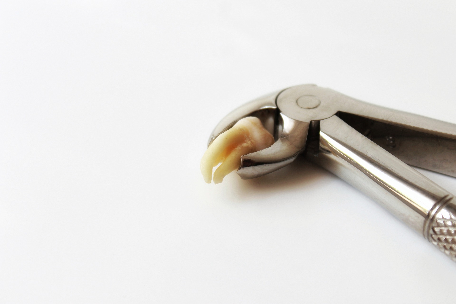 Reasons for Tooth Extractions