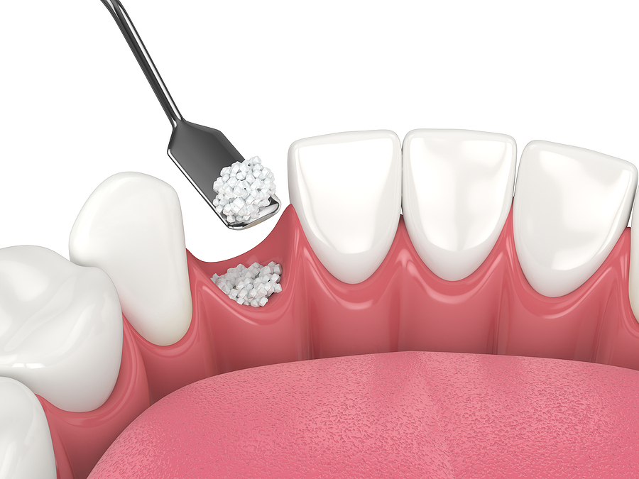 What Happens If I Don’t Have A Bone Grafting Procedure Performed Before My Dental Implants Are Placed?