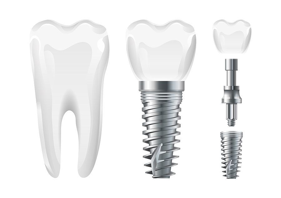 Understanding Dental Implant Abutments: A Key Component of a Lasting Smile